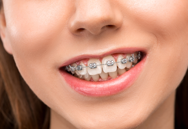 Ortodonti Tedavisi Batıkent 